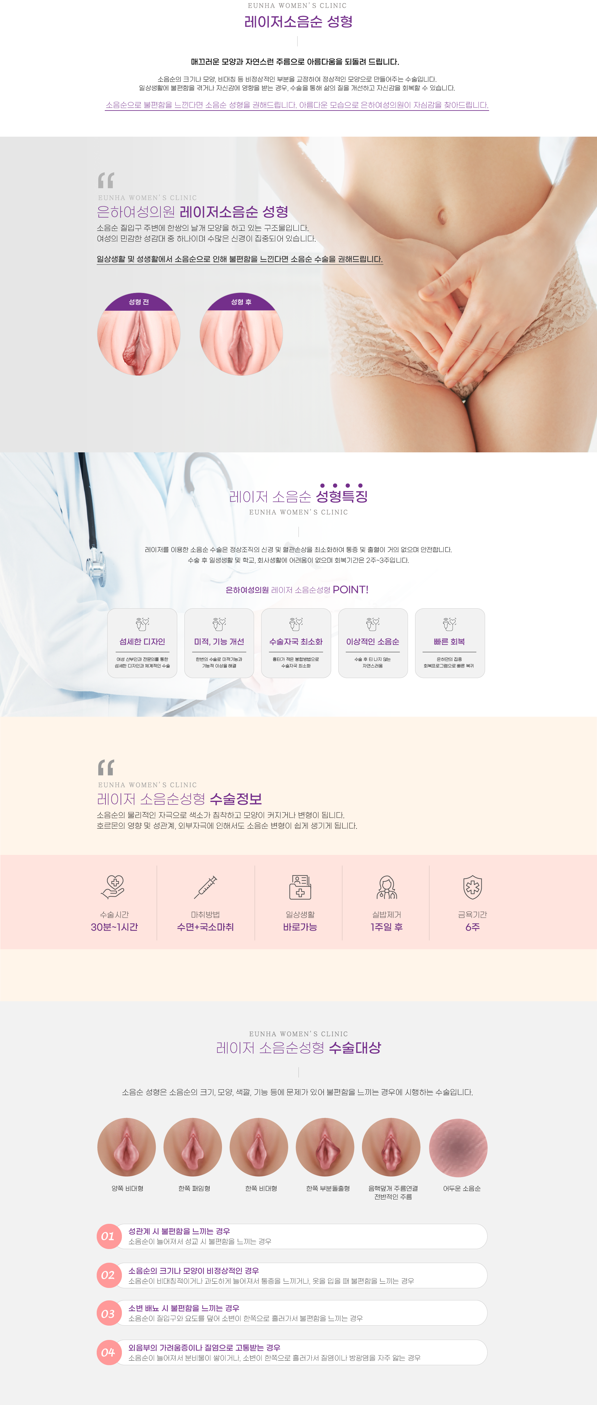 레이저 소음순성형6